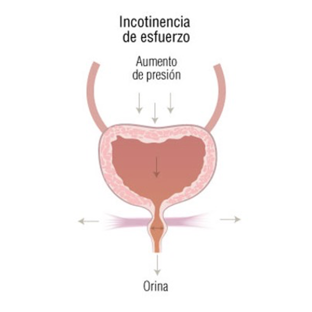 Ilustración médica sobre tipos de incontinencia urinaria